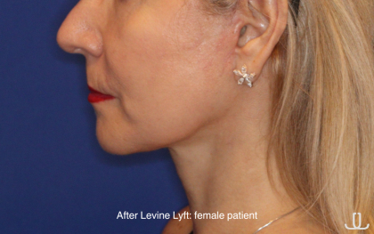 Facelift / Neck Lift Before & After Patient #16747