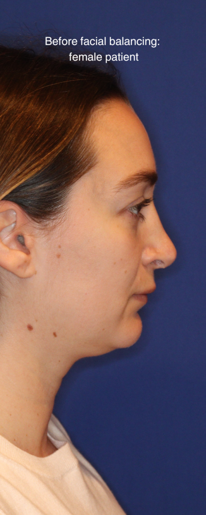 JL Facial Balancing Before & After Patient #16748
