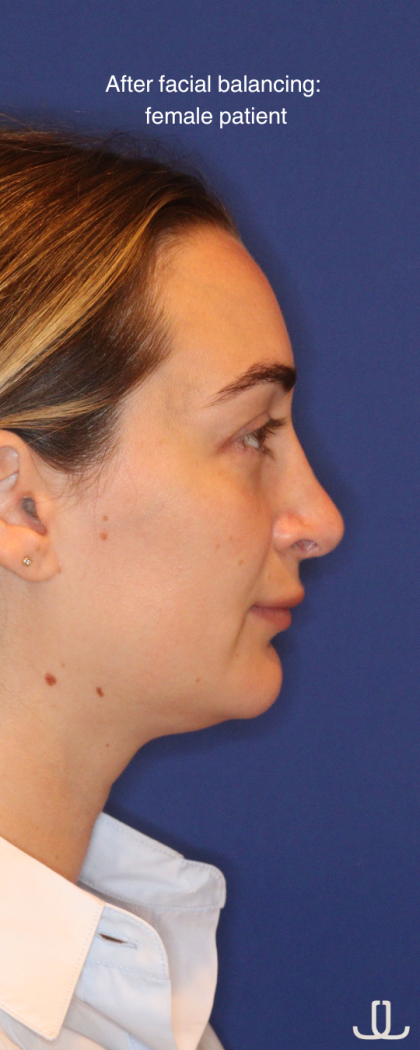 JL Facial Balancing Before & After Patient #16748