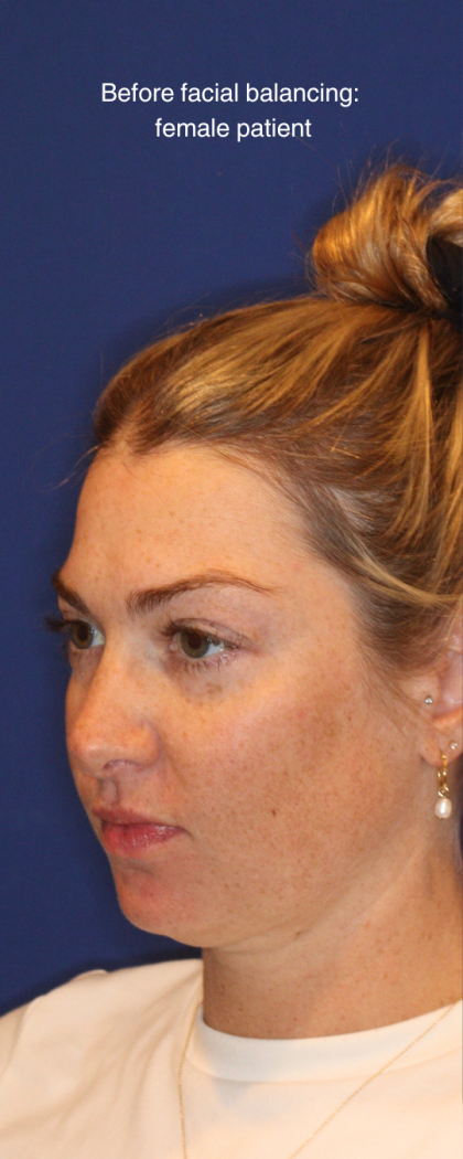 JL Facial Balancing Before & After Patient #16750
