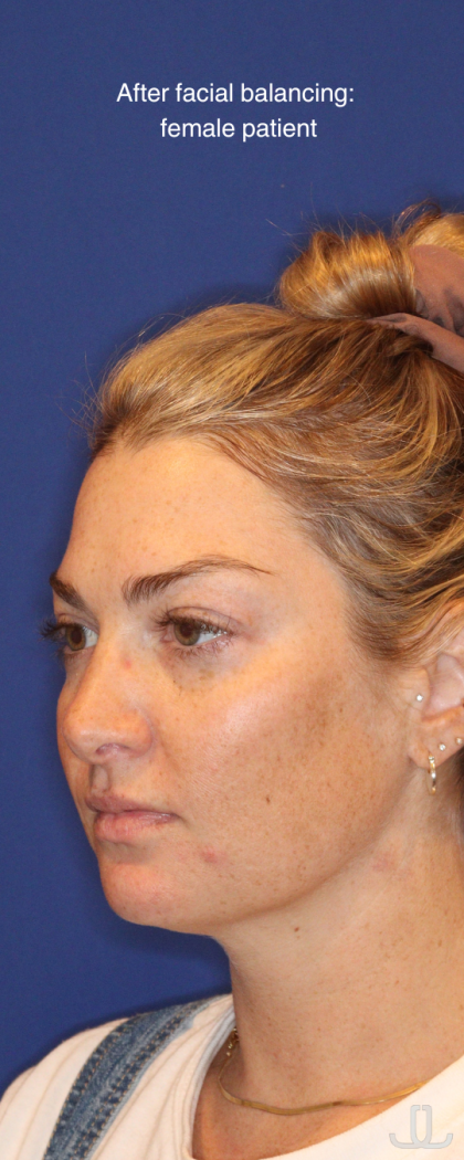 JL Facial Balancing Before & After Patient #16750