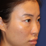 Non-Surgical Nose Job Before & After Patient #16752