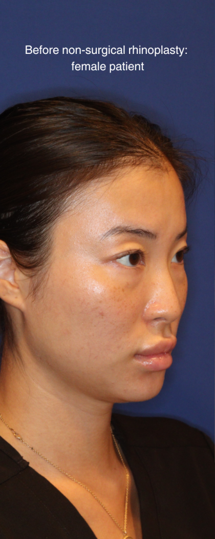 Non-Surgical Nose Job Before & After Patient #16752