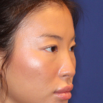 Non-Surgical Nose Job Before & After Patient #16752