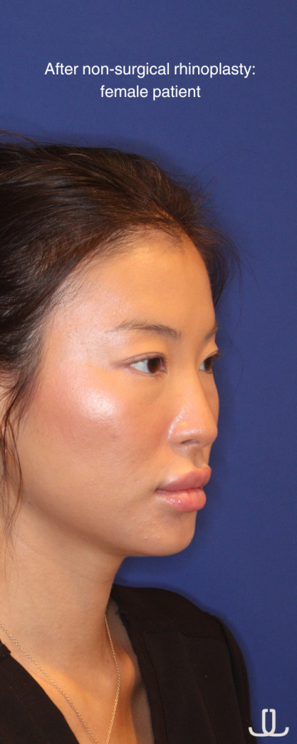 Non-Surgical Nose Job Before & After Patient #16752