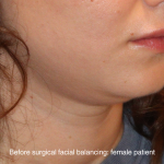 Chin Liposuction Before & After Patient #16743
