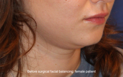 Chin Liposuction Before & After Patient #16743