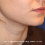 Chin Liposuction Before & After Patient #16743