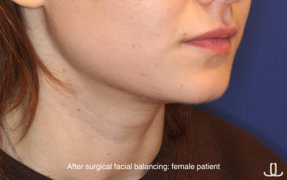Chin Liposuction Before & After Patient #16743