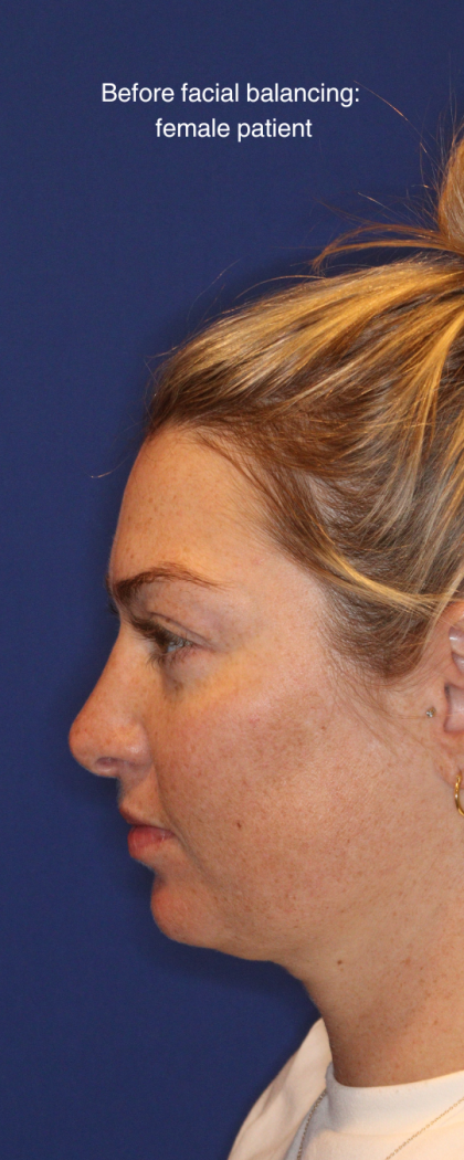 JL Facial Balancing Before & After Patient #16750