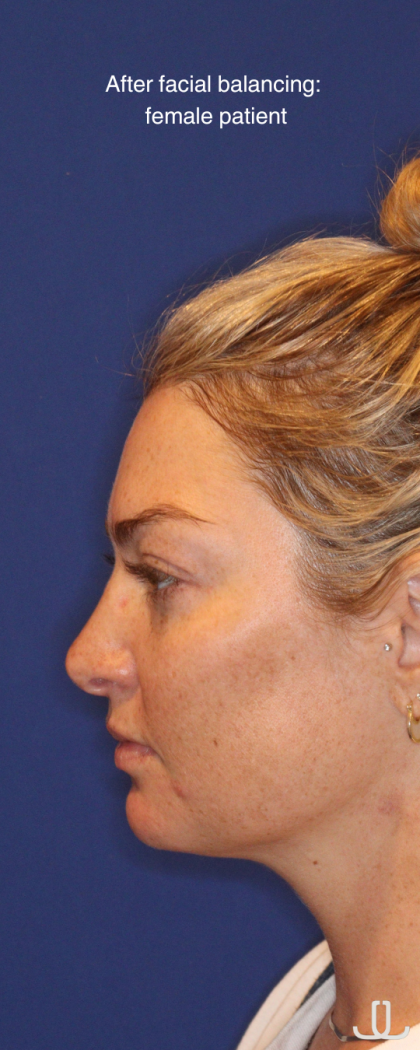 JL Facial Balancing Before & After Patient #16750