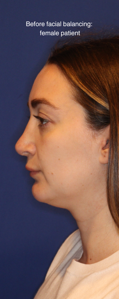 JL Facial Balancing Before & After Patient #16748