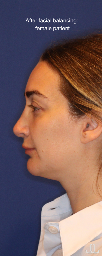 JL Facial Balancing Before & After Patient #16748